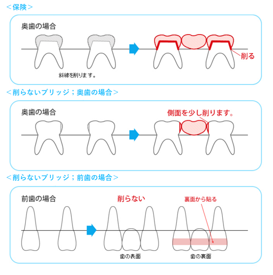 ブリッジ治療